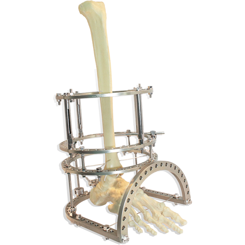 Circular External Fixator – Aerospace Aluminium