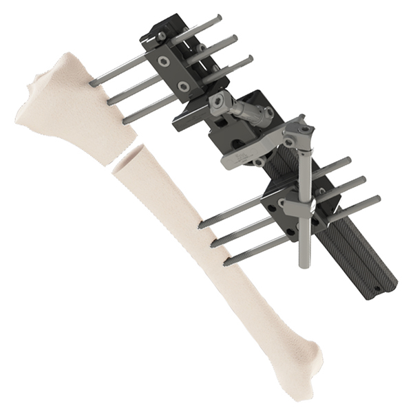 Genesis – Monolateral Fixation